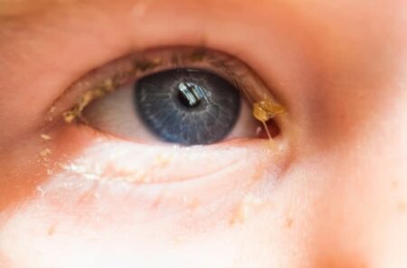 Proč se tvoří ospalky? Jde o důkaz zdravých očí. Pokud je ráno nemáte, měli byste zbystřit