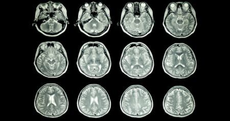 Naděje pro lidi trpící depresemi: Nová léčba spočívá v posílání magnetických pulsů do mozku. Byla úspěšná u 80 % účastníků