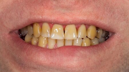 Bělení zubů zvládnete doma díky 6 zcela přírodním způsobům. Okolí vám nebude věřit, že jste nebyli u profesionála