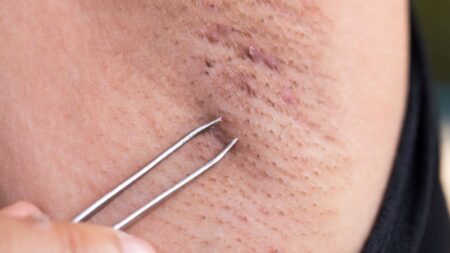 Zarostlé chloupky nemusí být problém. Dají se vyřešit snadno a hromadně, a také jim lze předcházet