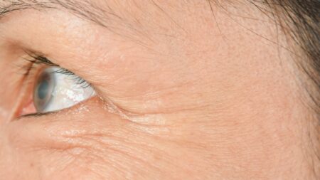 Nejsou vrásky jako vrásky. Ty na obličeji mohou kromě stárnutí značit také cukrovku, selhání ledvin a jiná onemocnění