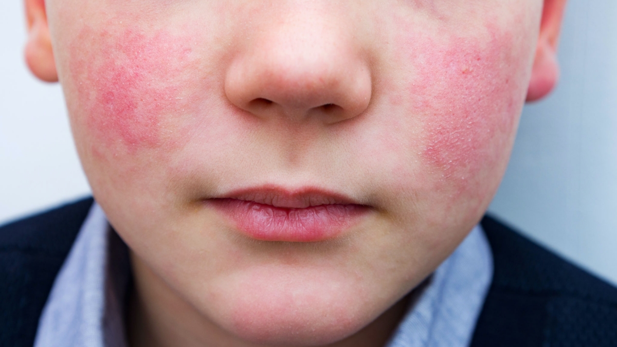 Znáte to – přijde trapná chvilka a v tu ránu se náramně podobáte rajčeti. Nežádoucí reflex zčervenání se ale dá ovládat