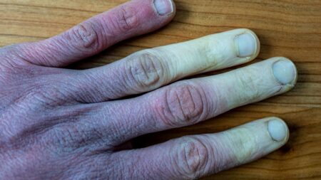 Zima nezabije hned –⁠ tekutina v buňkách těla pomalu zamrzá: Co se děje v těle během hypotermie