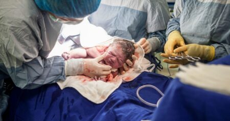 Vzácný případ dvojčat: Jedno se narodilo přímo v hlavě toho druhého. Žilo v něm 6 týdnů