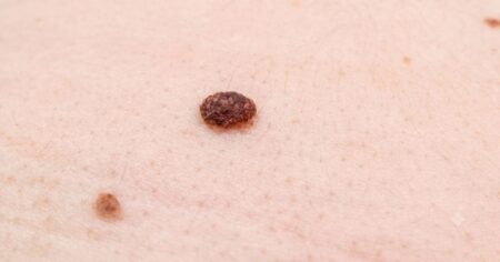 Změna velikosti, tvaru nebo barvy znaménka může patřit mezi příznaky melanomu